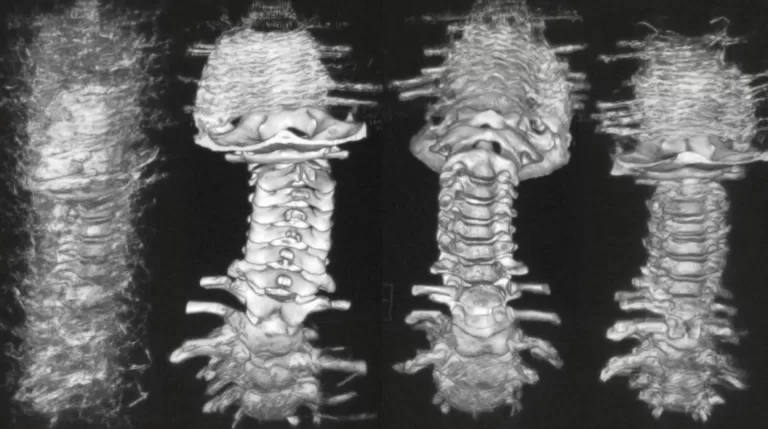 Что такое подвывих Атланта? Какие виды подвывиха Атланта бывают?
