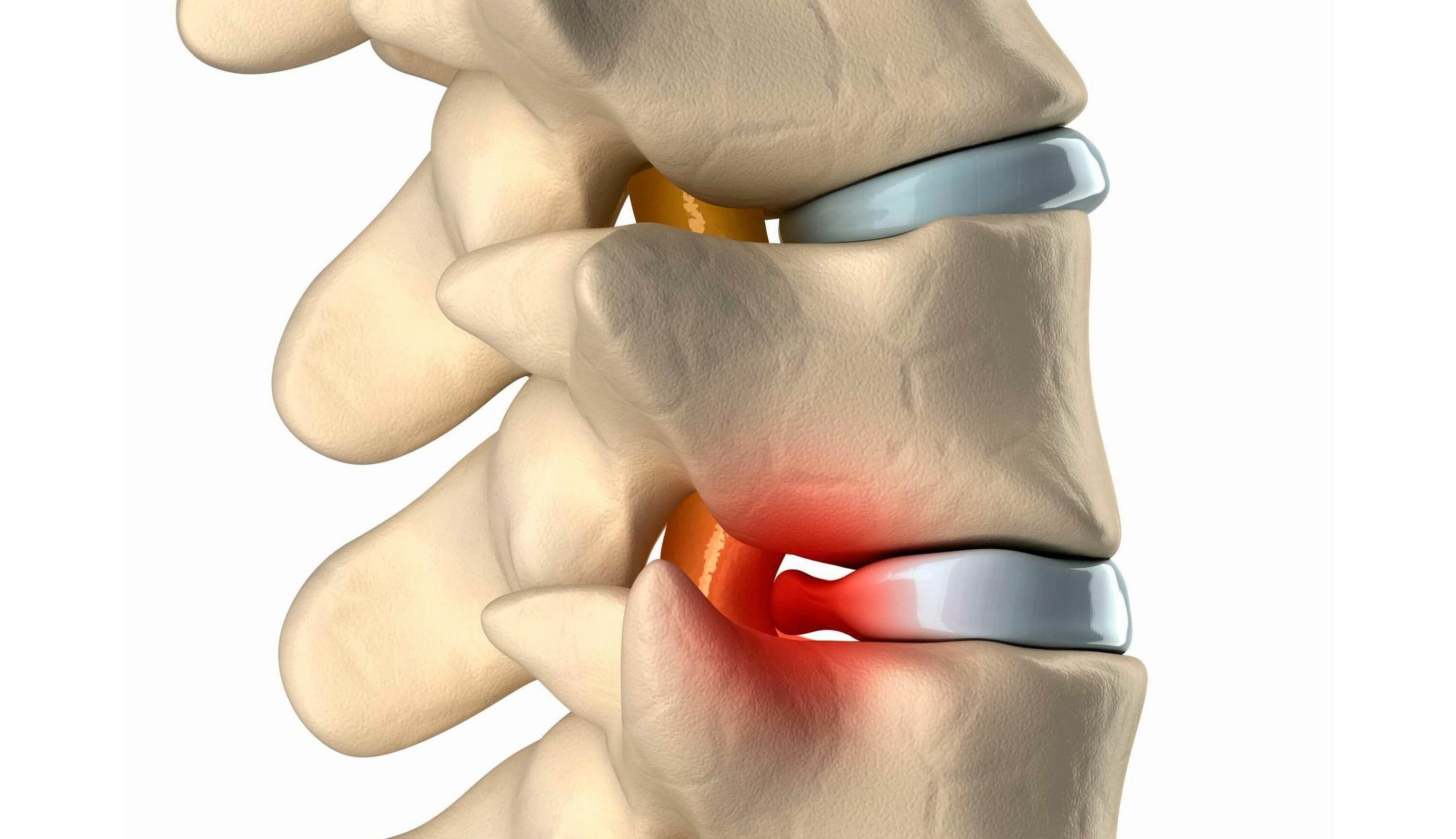 Межпозвоночная грыжа
