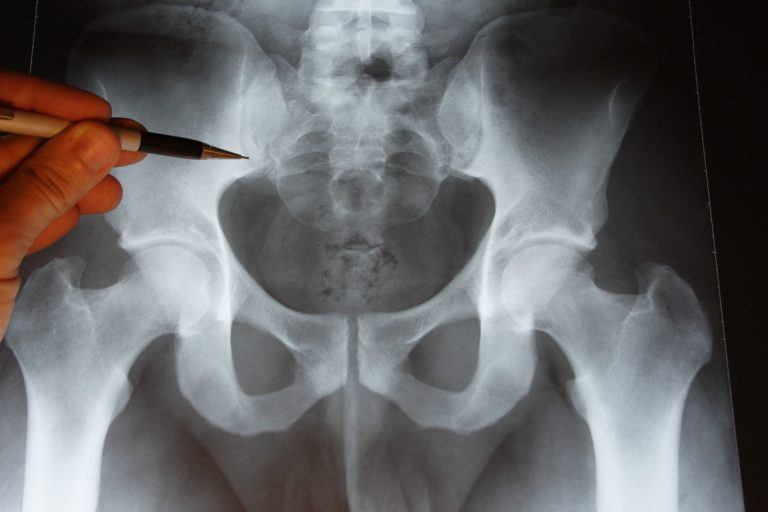 Тест по медицине: Что вы знаете о кокцигодинии?