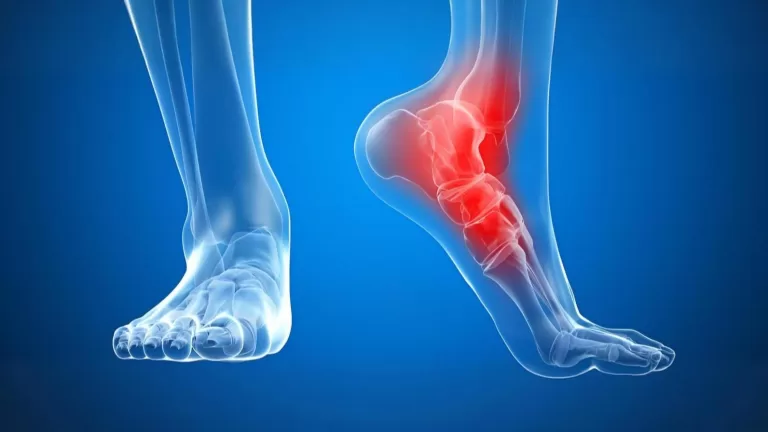 Патогенез и классификация бурсита сустава